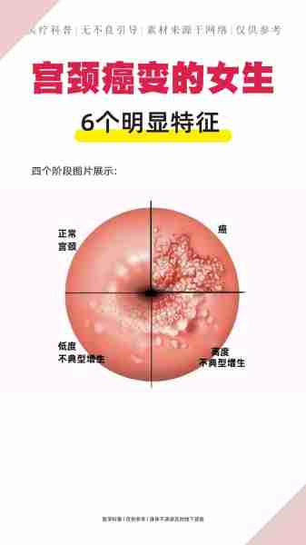 癌癌早早癌期（早期癌包括）